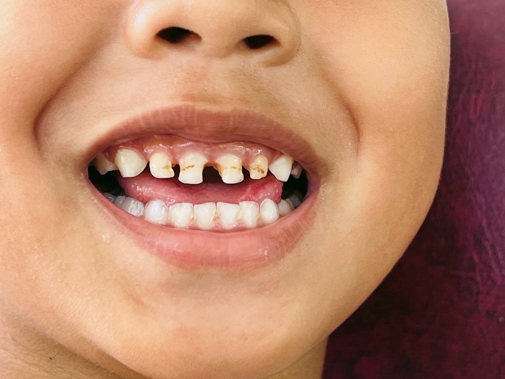 Tooth Decay in Kids Dripping Springs