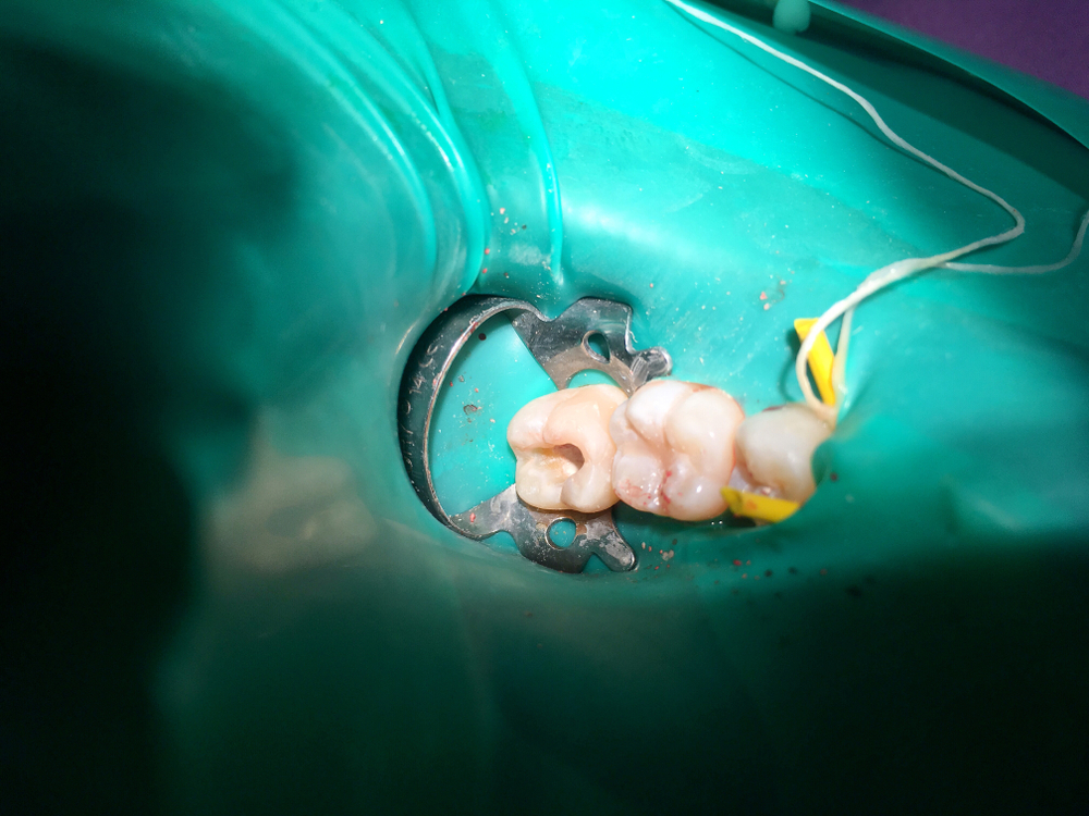 Pulpotomy Dripping Springs
