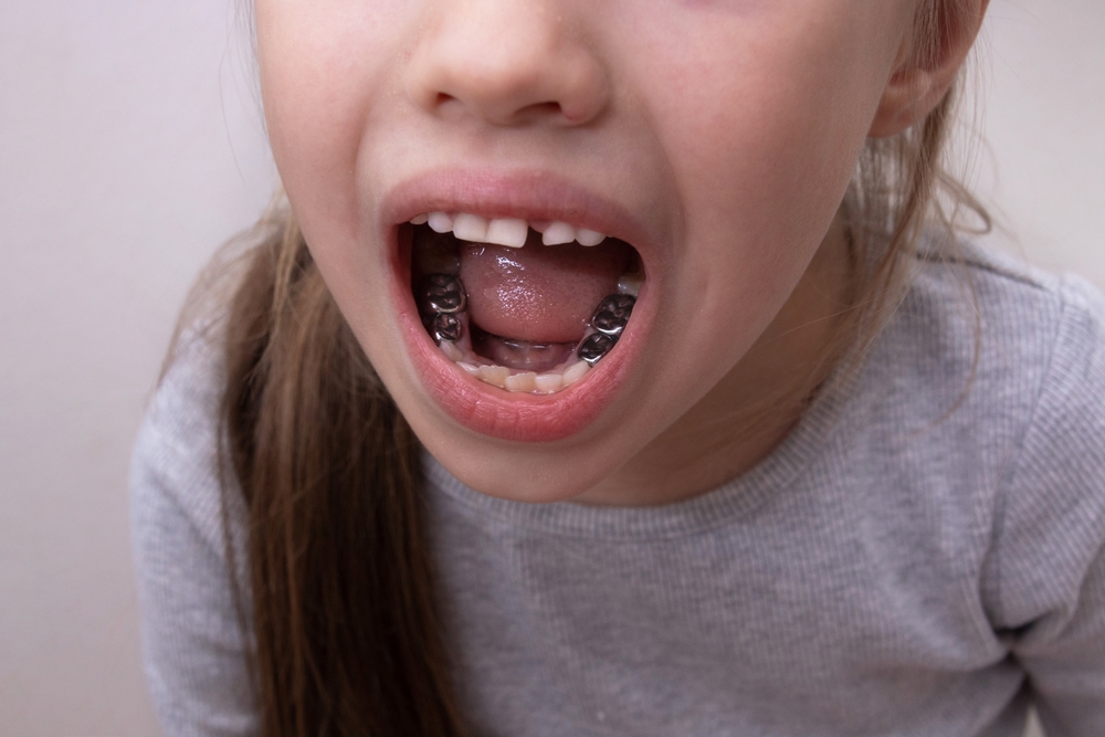 Pediatric Crowns Central Austin